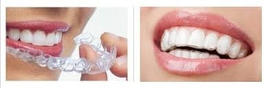 Orthodontist Braces Cost Raleigh NC